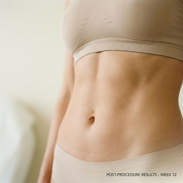Abdominoplastia